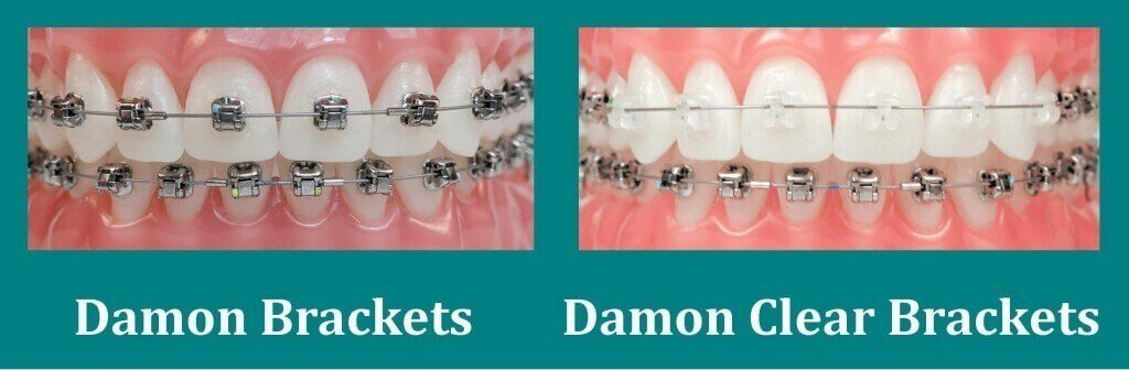 Tipuri aparate dentare