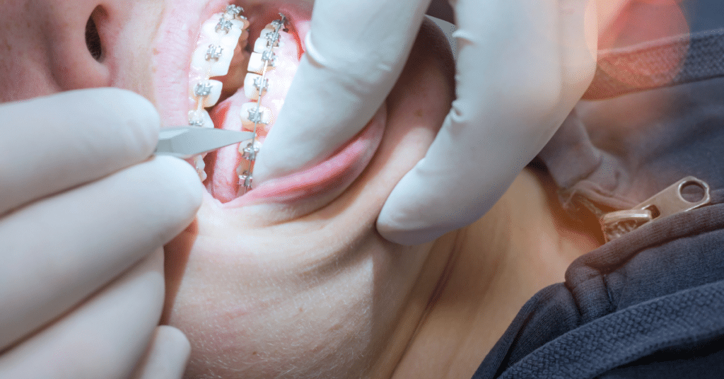Recomandări aparat dentar